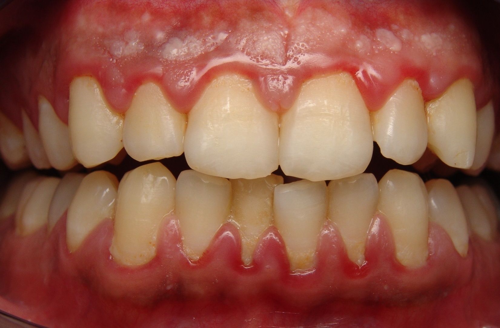 periodontal disease