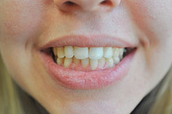 Altman Dental Patient Before Teeth Whitening