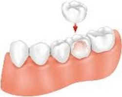 A porcelain crown is placed on top of a prepared tooth. The crown is matched to the shades of your other teeth.