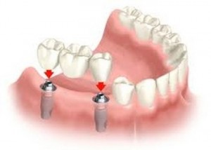 Dental Implants at Altman Dental