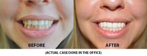 Before and After Tooth Whitening at Altman Dental
