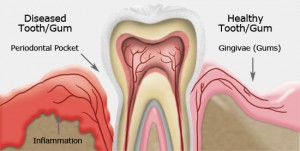 gum disease illustration
