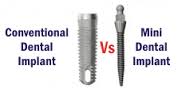 traditional implant vs mini dental implant