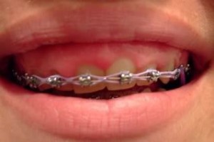 swelling gums and braces