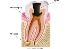 abscessed tooth