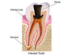 abscessed tooth