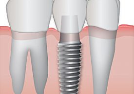 dental implant